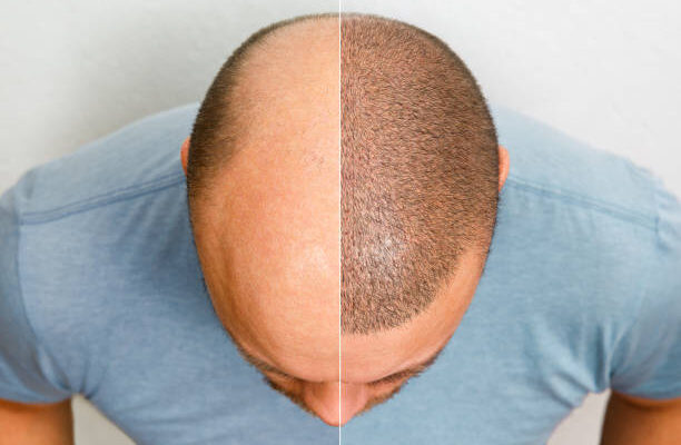 Hair Transplant in Abu Dhabi