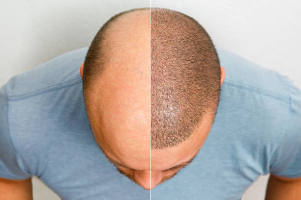 Hair Transplant in Abu Dhabi