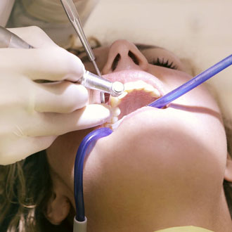 dentist for deep cleaning near San Jose.