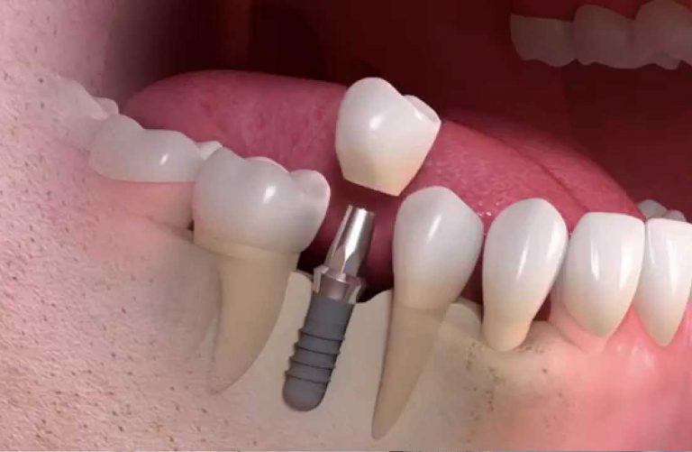 Dental Implants in Aberdeen: A Comprehensive Guide