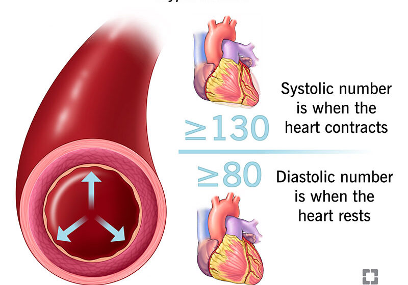 high blood pressure