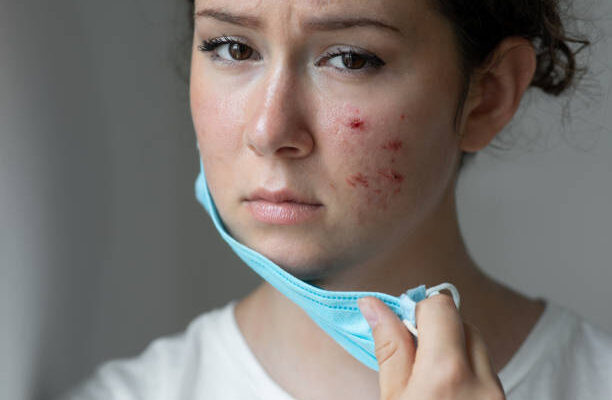 Acne treatment in Abu Dhabi