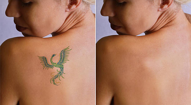 Laser Tattoo Removal in Abu Dhabi