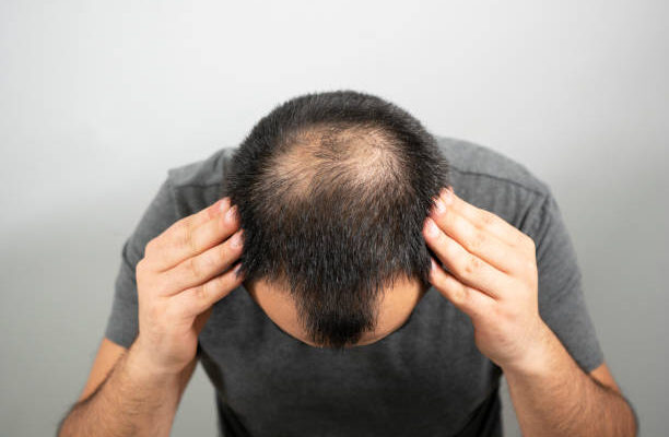 hair transplant in Abu Dhabi