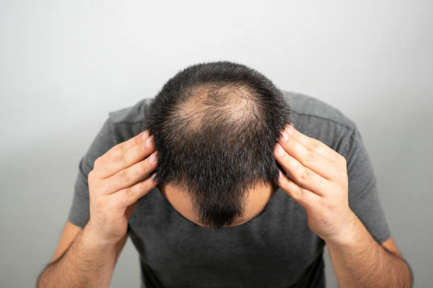 Hair Transplant in Abu Dhabi: What to Expect from the Procedure