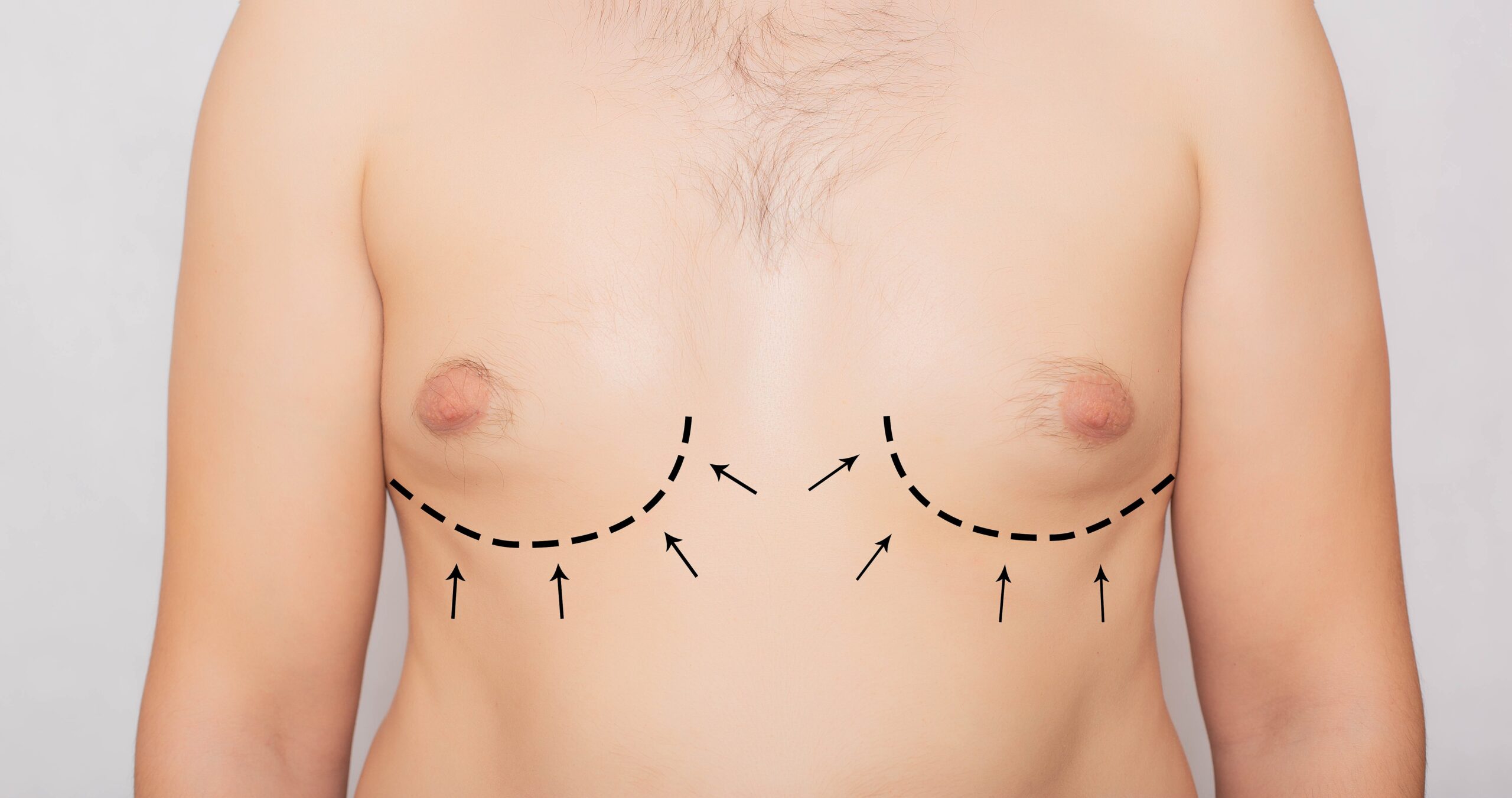 Gynecomastia Correction in Dubai: A Life-Changing Procedure