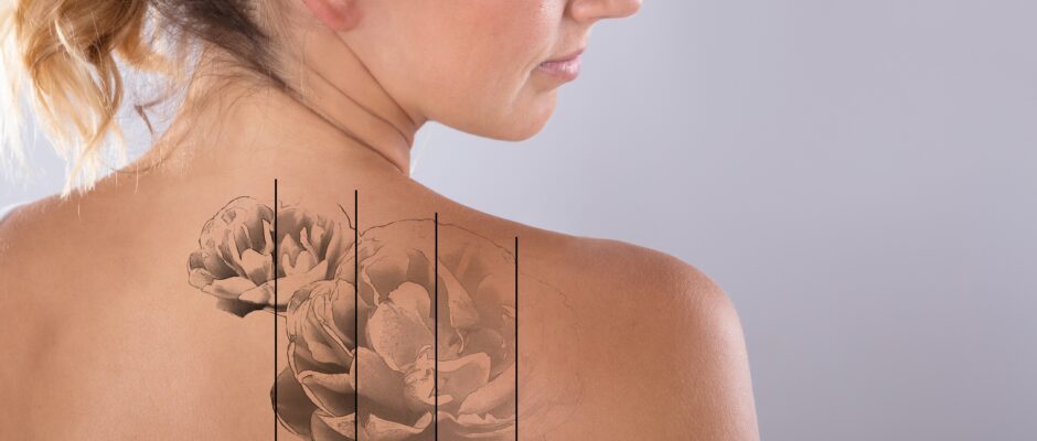 Laser,Tattoo,Removal,On,Woman's,Shoulder,Against,Gray,Background