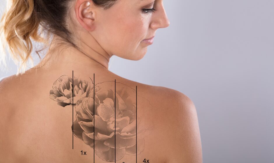 Laser,Tattoo,Removal,On,Woman's,Shoulder,Against,Gray,Background