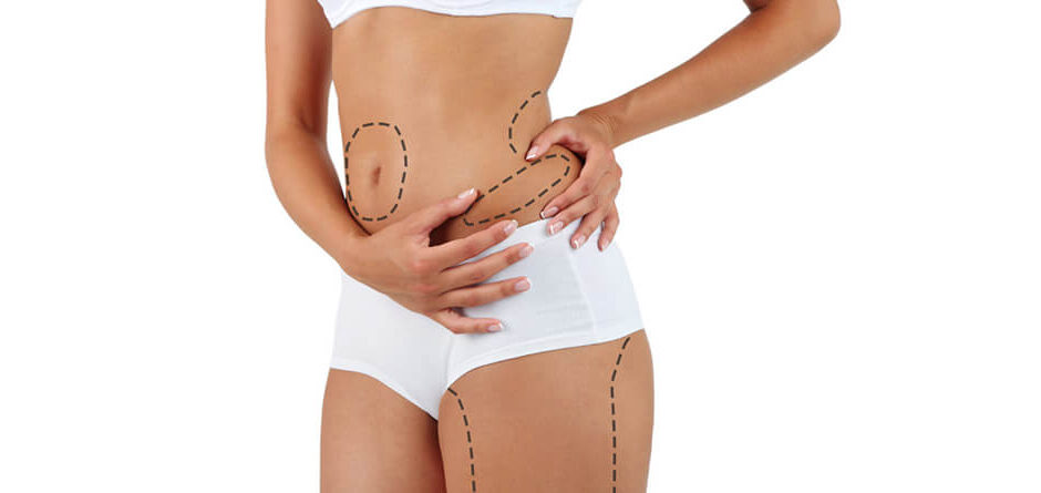 Liposuction in Islamabad