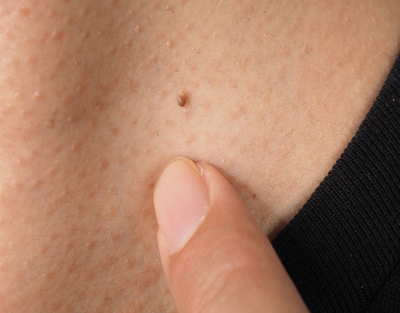 Skin Tag Removal Dubai: Is it Painful and How Long Does it Take?