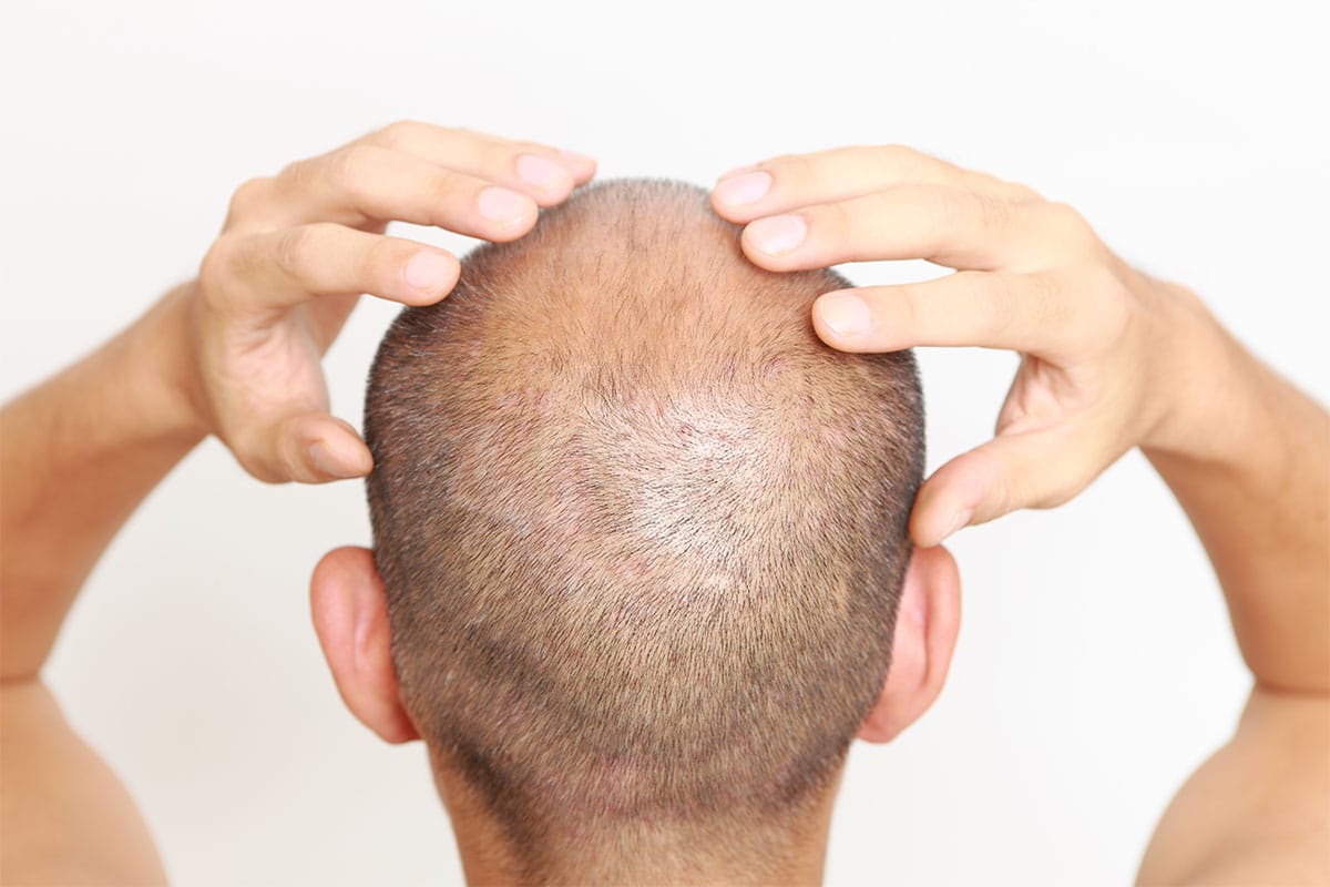 Hair Transplant Financing Options in Dubai: Making Your Dream Hair Affordable