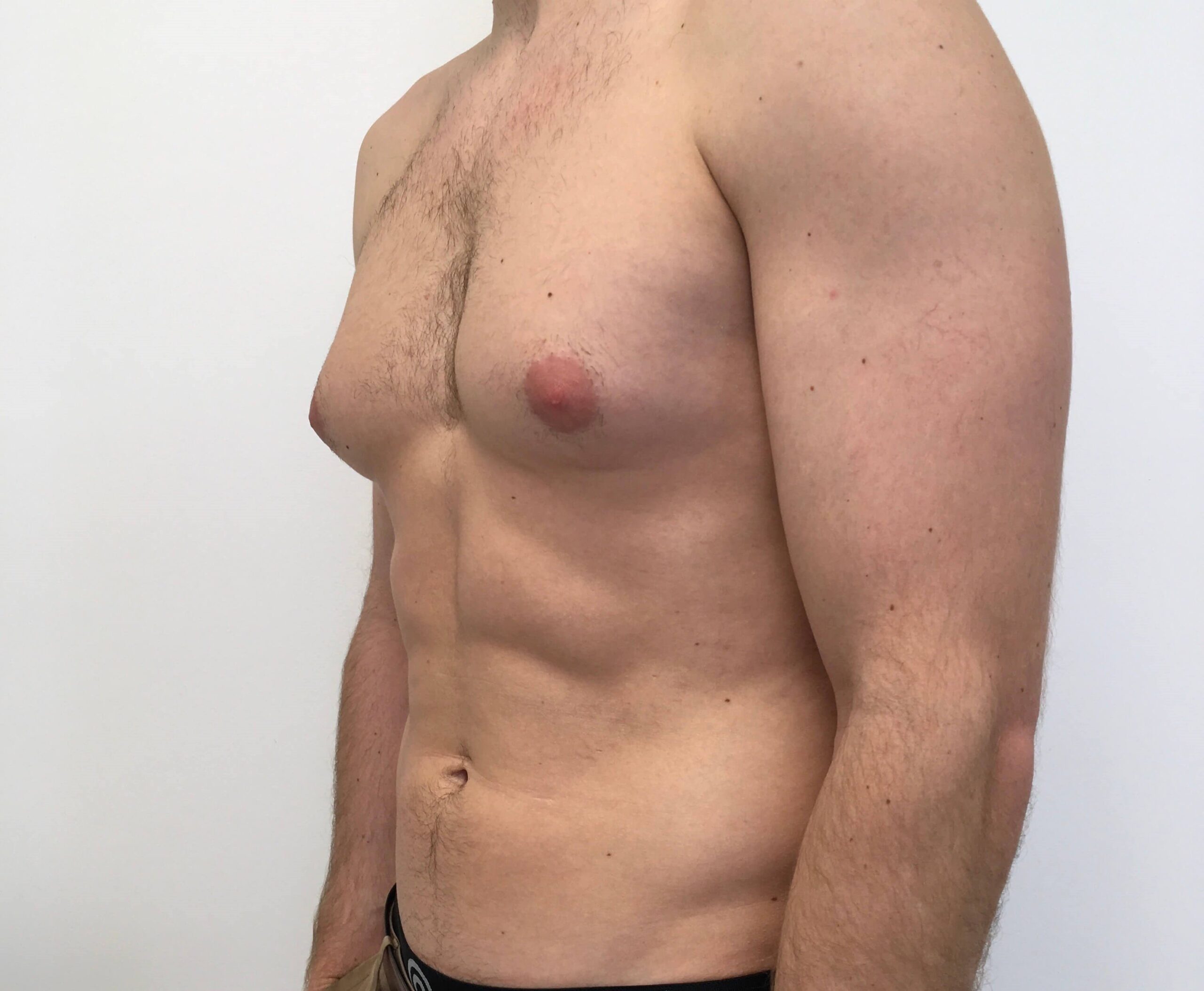 Exploring Non-Surgical Gynecomastia Treatments in Dubai