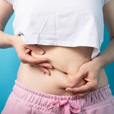 Liposuction in Islamabad.