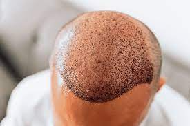 Can Hair Transplants Fail, and Why Does It Happen