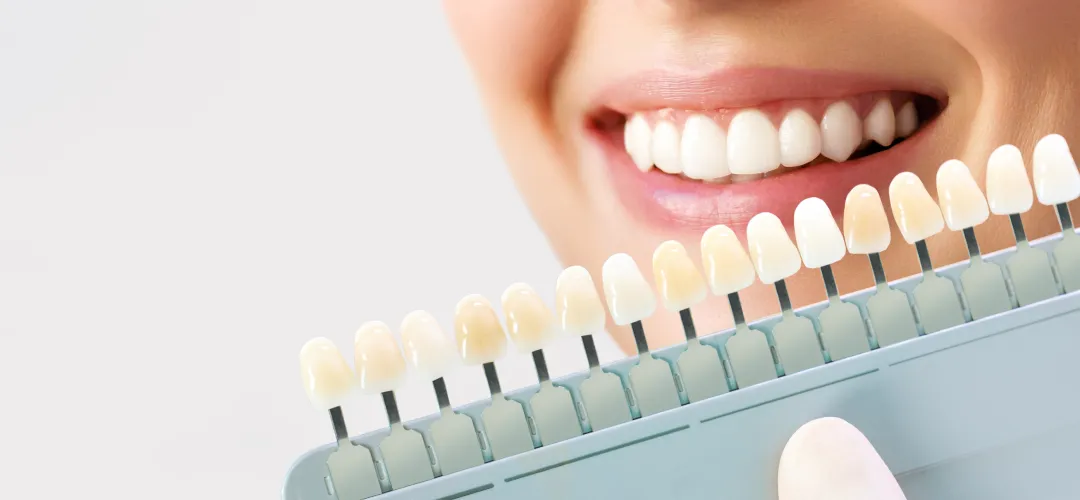 Dental Veneers Cost Dubai