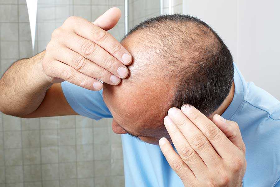 How Long Does a Hair Transplant in Dubai Last?