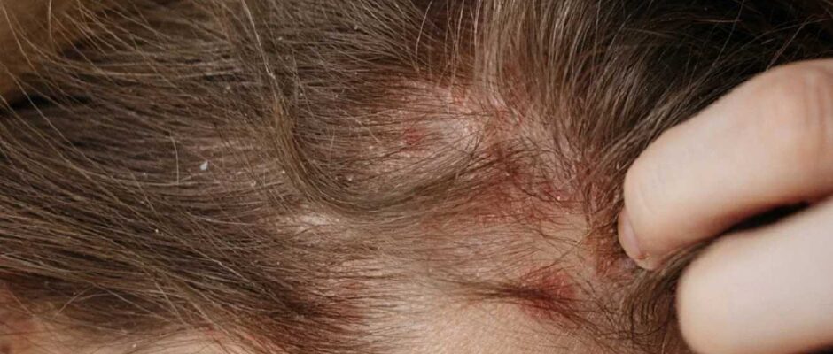 scalp eczema