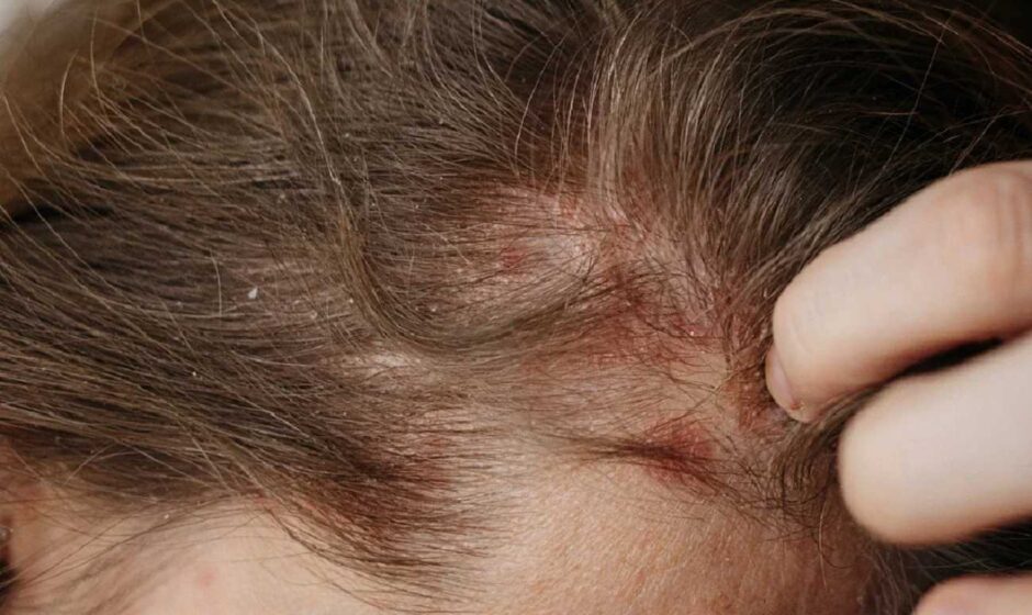 scalp eczema