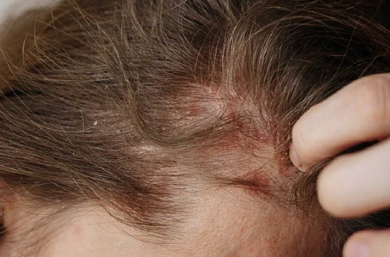 Can Eczema Make You Go Bald? Causes, Symptoms, and Treatment