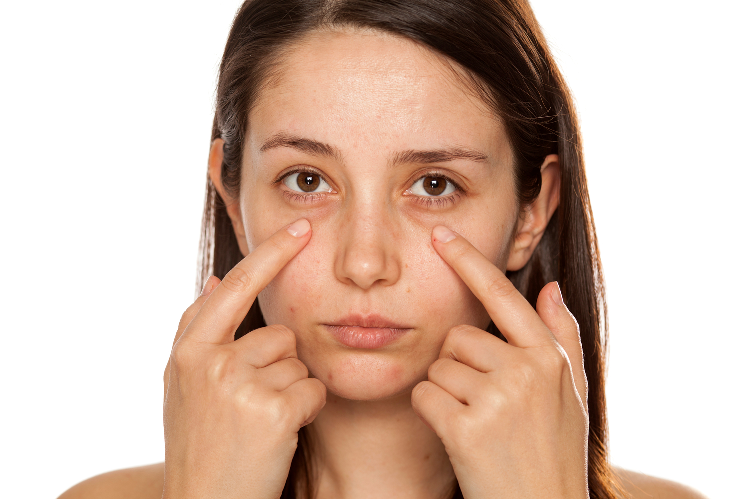 Are There Any Non-Invasive Dark Circles Treatments?