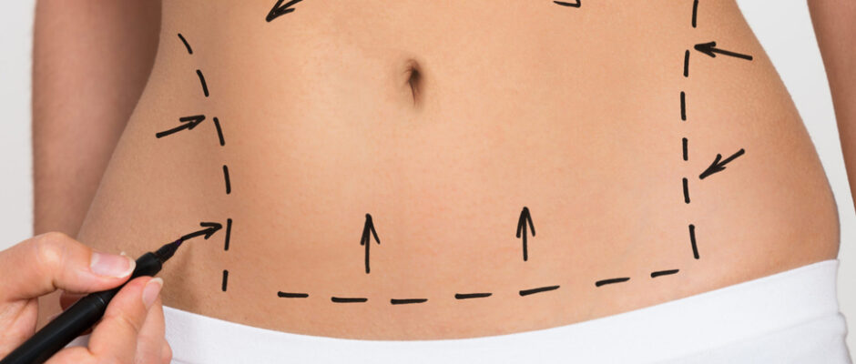 Best Lipo Abdominoplasty in Dubai 