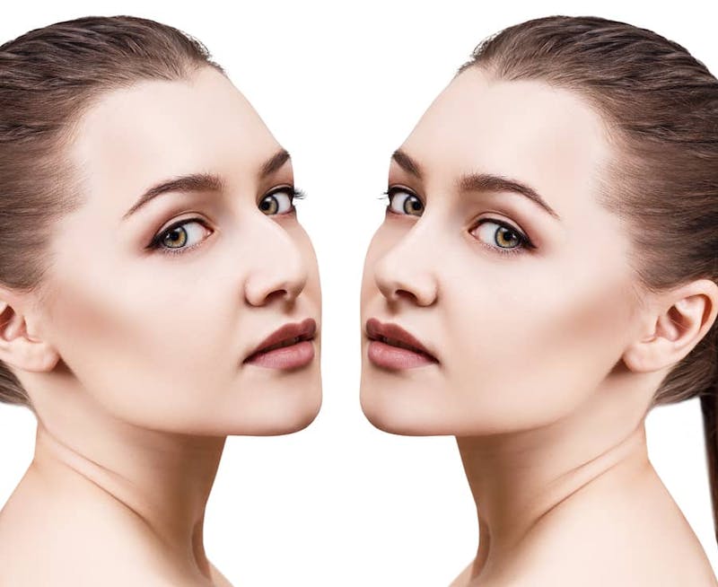 Can Rhinoplasty Fix Nasal Deformities