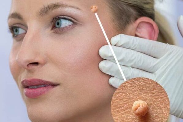 Wart Removal Clinic in Dubai: How to Find Affordable Treatment