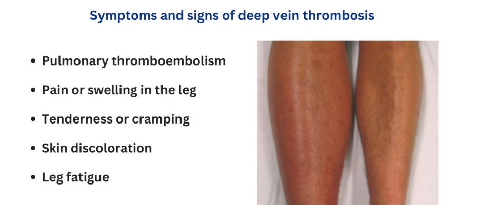 dvt symptoms