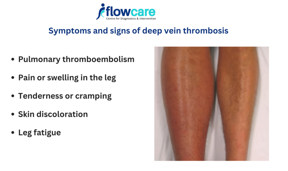 dvt symptoms