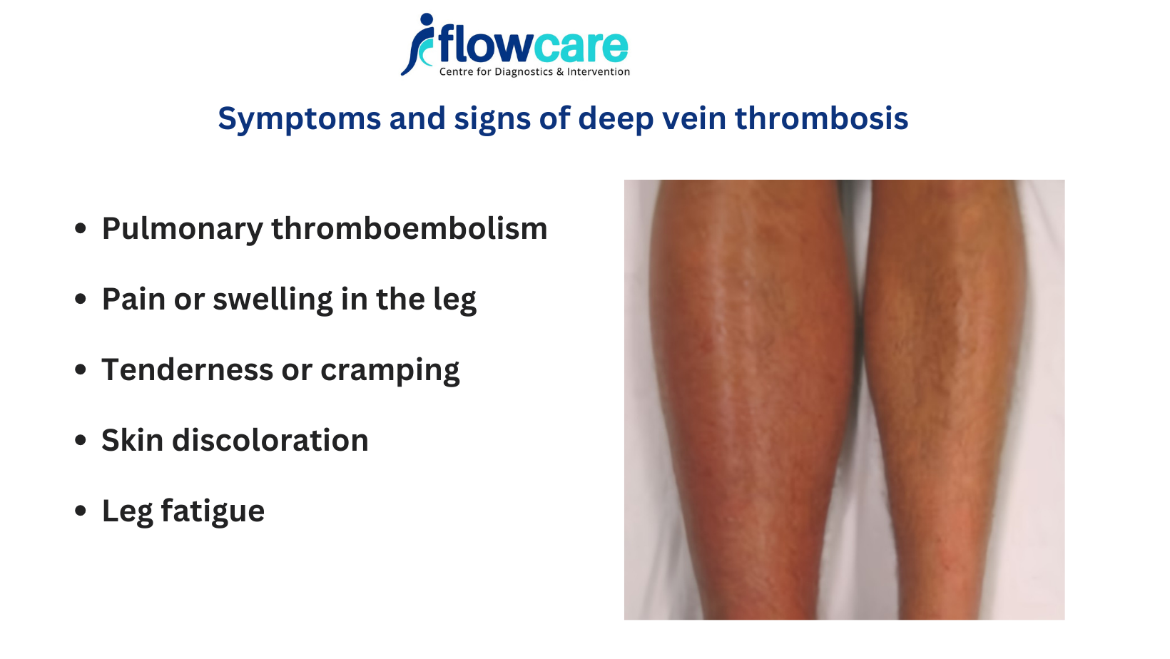 dvt symptoms