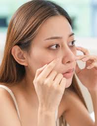 Carboxytherapy for Dark Circles: A Revolutionary Treatment