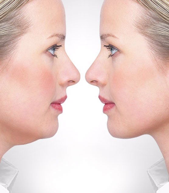 Double Chin and Aging: How to Restore a Youthful Look