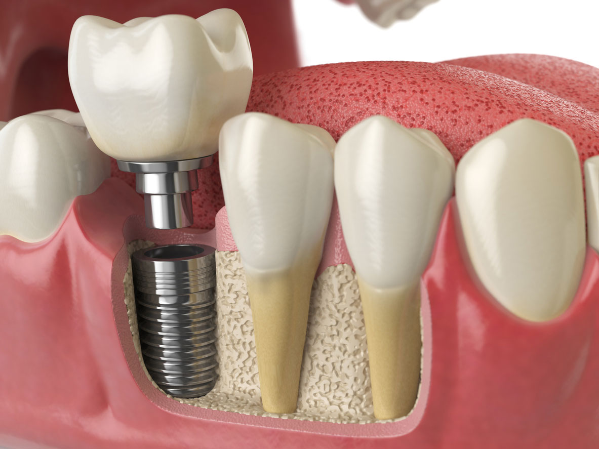 How Dental Implants Are Changing Dental Care in Dubai