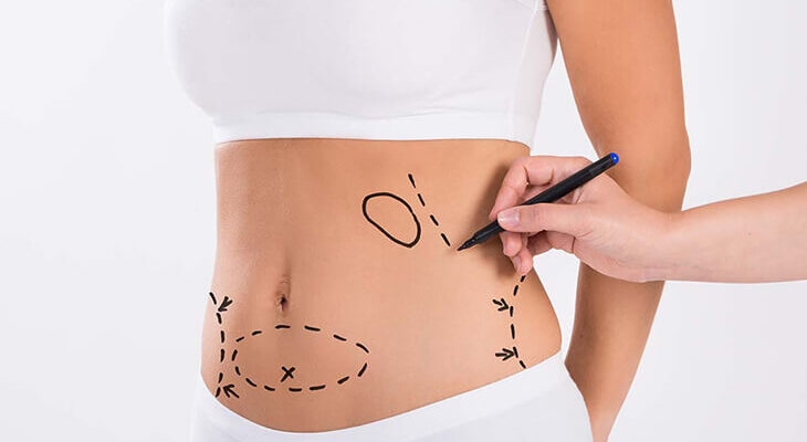 How Lipo Abdominoplasty Shapes Your Body