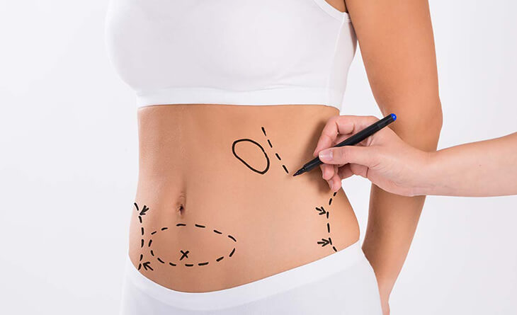 How Lipo Abdominoplasty Shapes Your Body