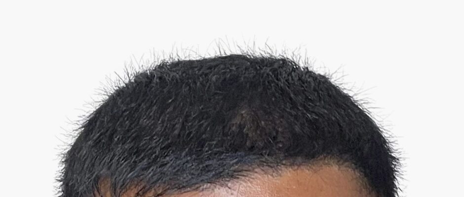 How Long Do the Results of a Hair Transplant Last in Dubai