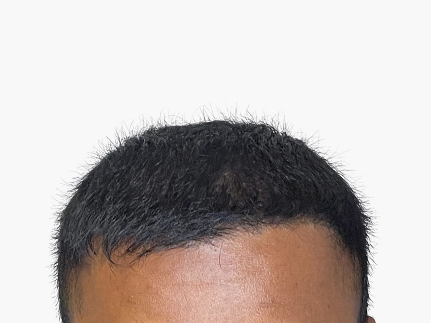 How Long Do the Results of a Hair Transplant Last in Dubai