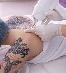 Picosure Tattoo Removal in Dubai