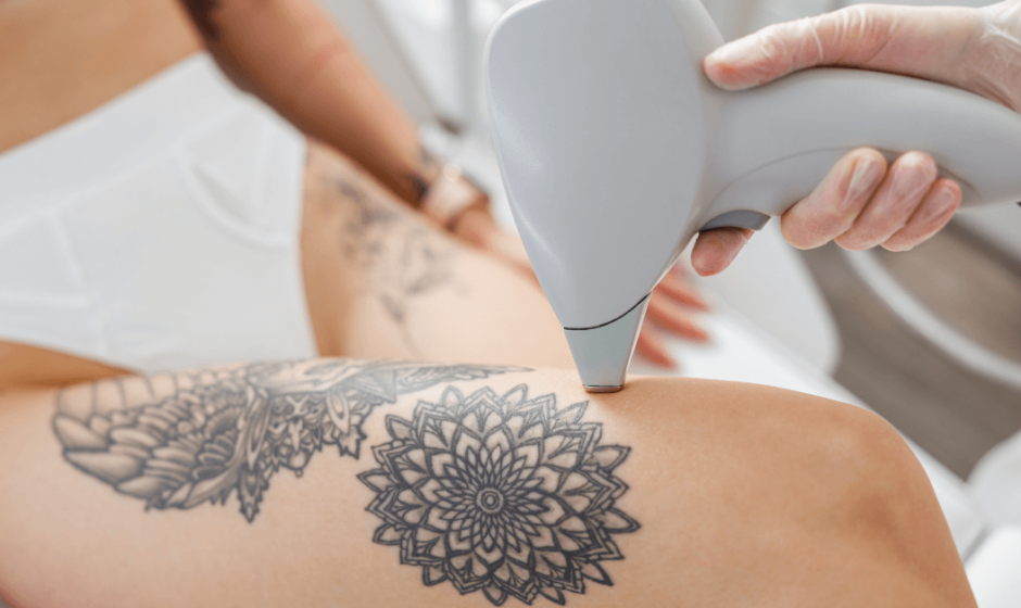 Picosure Tattoo Removal in Dubai