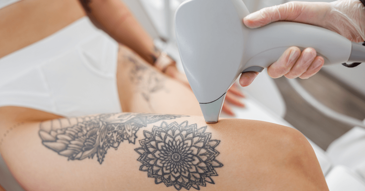 Picosure Tattoo Removal in Dubai