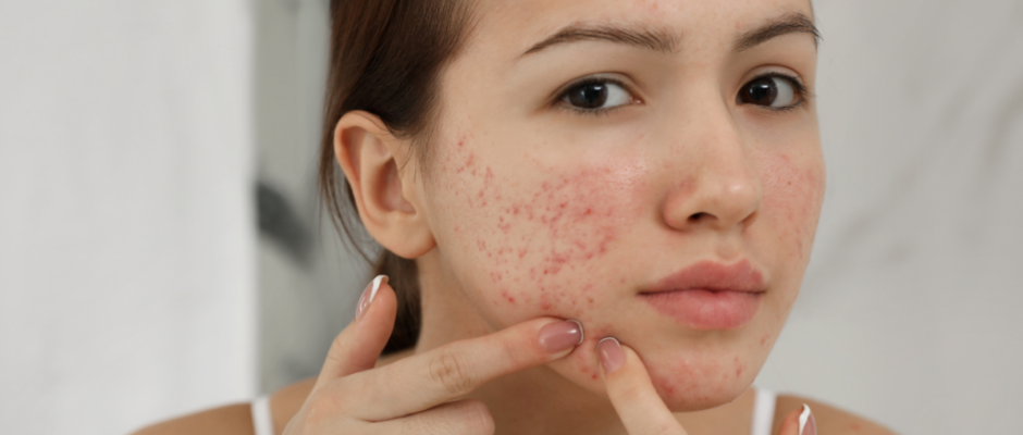 Say Goodbye to Scars: Effective Acne Scar Solutions in Dubai