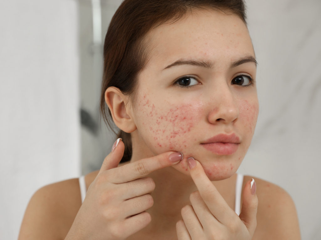 Say Goodbye to Scars: Effective Acne Scar Solutions in Dubai