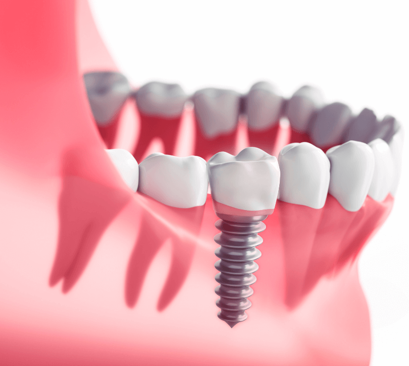 Single Tooth Implants