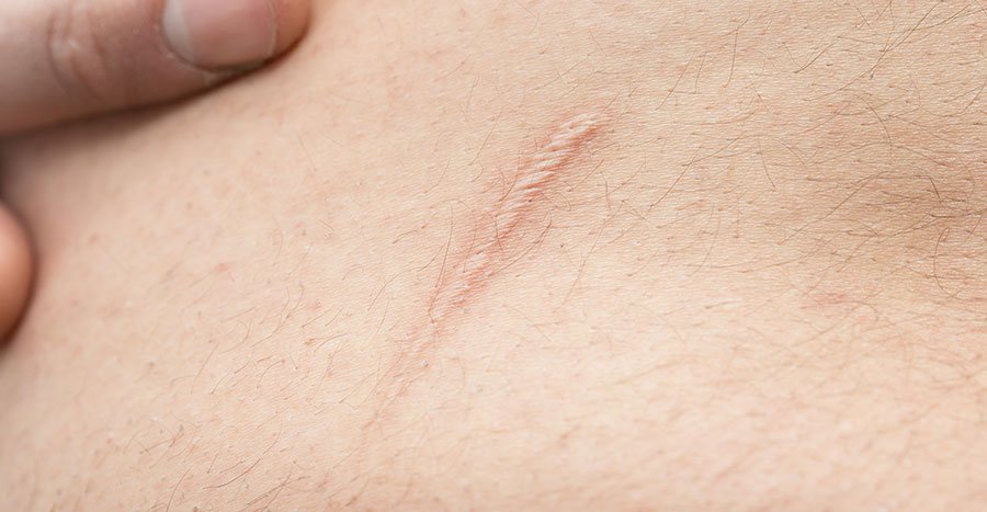 Smooth, Flawless Skin Awaits with Surgical Scar Revision