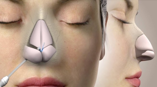 Rhinoplasty Surgery Can Change Your Look Forever