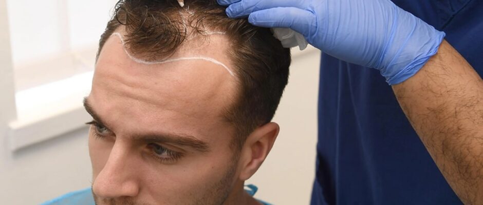 What Are the Benefits of Hair Transplant in Dubai