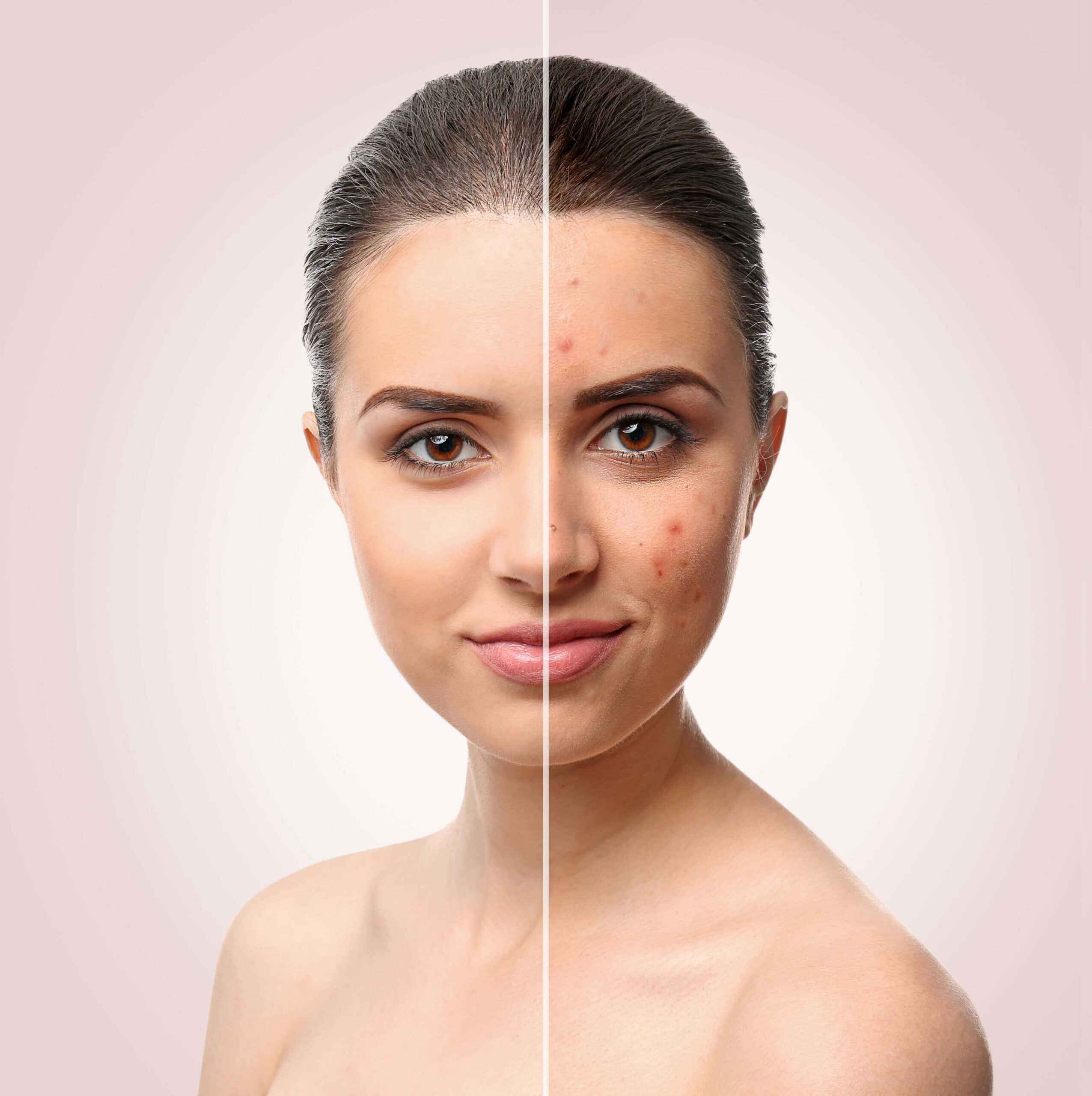 How Long Do Results Last for Acne Scar Treatment in Islamabad?