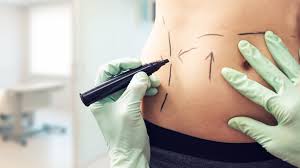 Liposuction Dubai