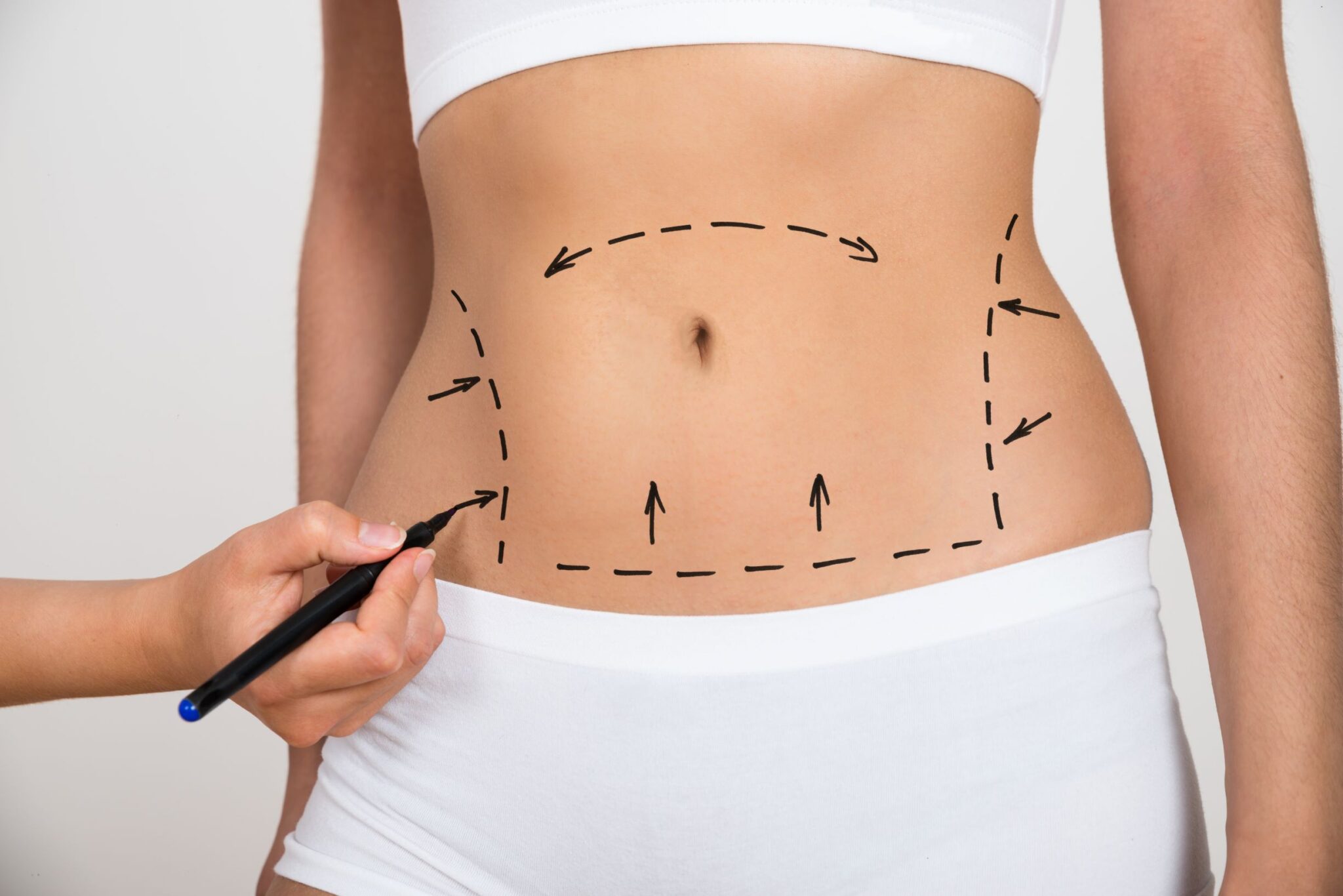 Body Liposuction: Reshaping Lives, Sculpting Confidence