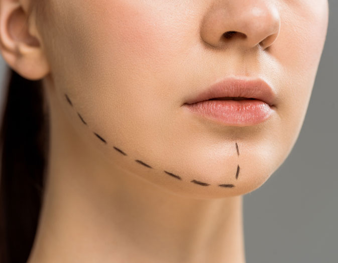 Chin Reduction: Is It Covered by Insurance